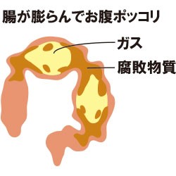 頑固な便秘の原因